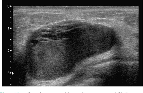 Table 1 From Complex Cystic Breast Masses In Ultrasound Examination