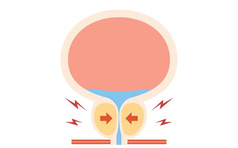 Conheça o Holep a cirurgia a laser altamente eficaz no tratamento da