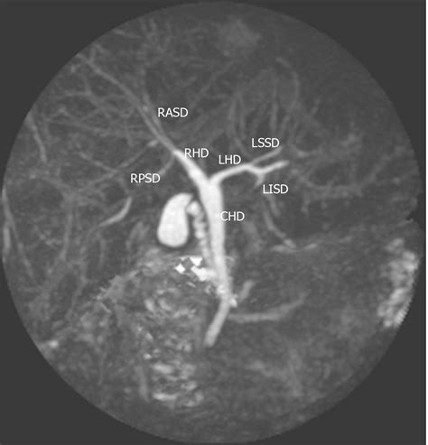 Anatomic Variations Of The Intra Hepatic Biliary Tree In The Caribbean