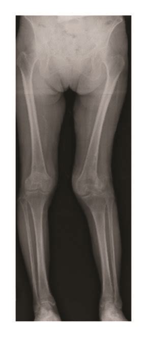 Preoperative Plain Radiograph And Computed Tomography Anteroposterior