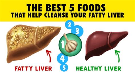 🍊 The Best 5 Foods That Help Cleanse Your Fatty Liver Youtube