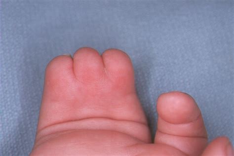 Birth Bilateral Complex Syndactyly Reconstructed In Three Stages