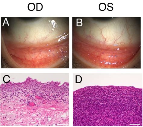 Conjunctival Lymphoma Arising From Reactive Lymphoid Hyperplasia World Journal Of Surgical