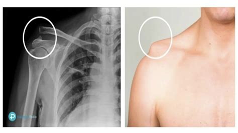 24 Lesion De La Articulacion Acromioclavicular – Otosection