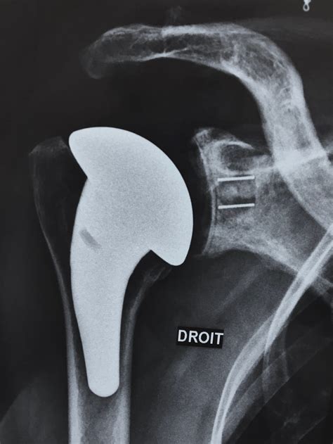 Tout savoir sur la prothèse d épaule Clinique Ostéo Articulaire des