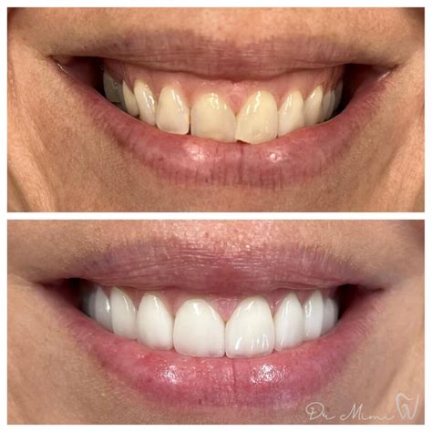 Laser Gum Lift And Contouring Westlake Smile Studio