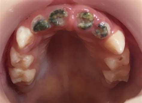 Intraoral Examination Showing Maxillary Primary Incisors With Extensive