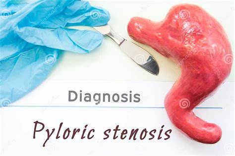 Diagnosis Of Pyloric Stenosis Figure Stomach Scalpel And Surgical