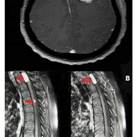 (A,B) brain MRI with contrast axial section showing frontal convexity... | Download Scientific ...