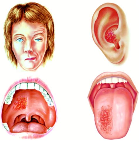 Ramsay Hunt Syndrome Information & Awareness