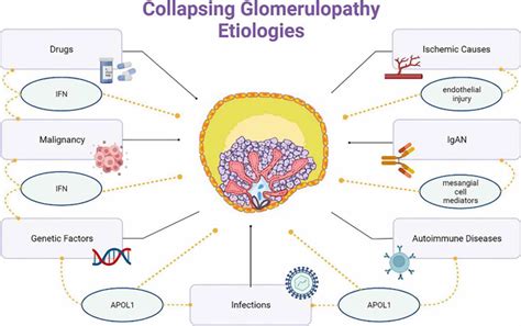 Collapsing Glomerulopathy Causes Symptoms Diagnosis Treatment