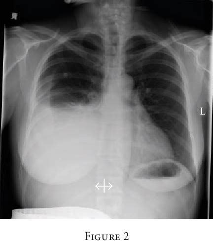 Figure From Symptomatic Isolated Pleural Effusion As An Atypical