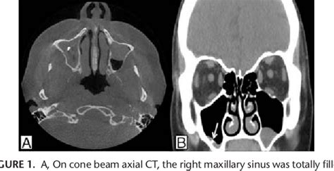 Foreign Body Removal by Inferior Meatal Antrostomy | Semantic Scholar