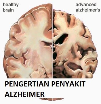 Pengertian Penyakit Alzheimer Gejala Risiko Dan Pengobatan