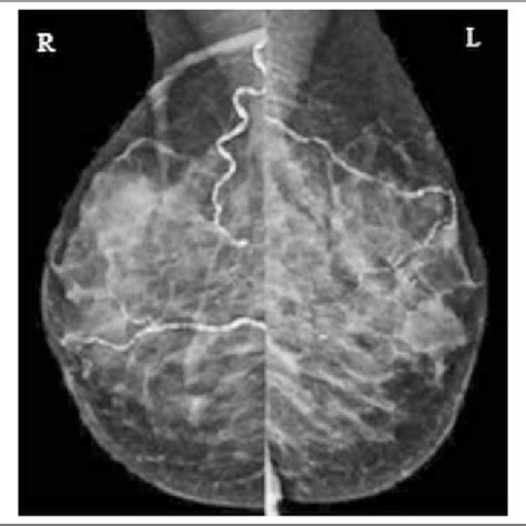 PDF Association Of Breast Arterial Calcification Andosteoporosis In