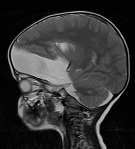 Large Arachnoid Cyst Image Radiopaedia Org