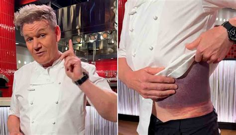 Video Gordon Ramsay Reveals Horrific Injuries After Bicycle Accident