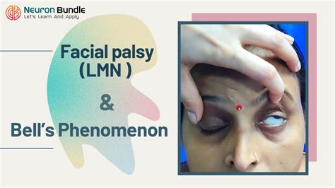 Bells Phenomenon And Lmn Facial Bells Palsy Clinical Features Lmnvsumn Cranialnerveexam