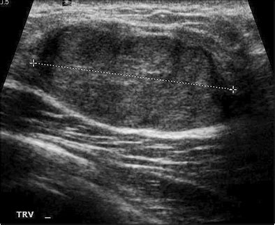 Palpable Clinical Concern In A Year Old Girl Transverse Breast