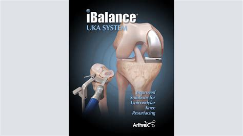 Arthrex IBalance UKA System