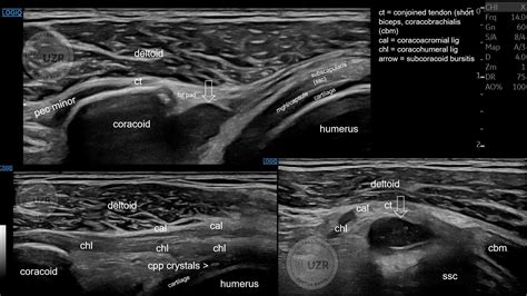 Subcoracoid Bursitis