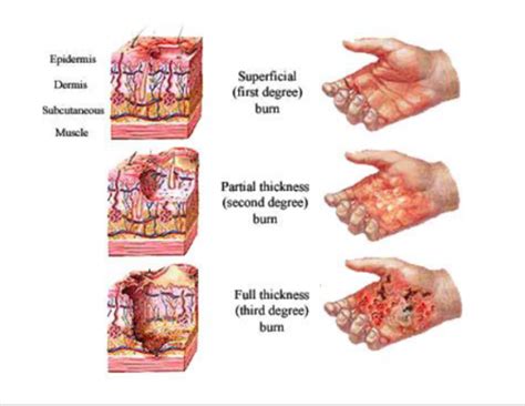 Burns Flashcards Quizlet