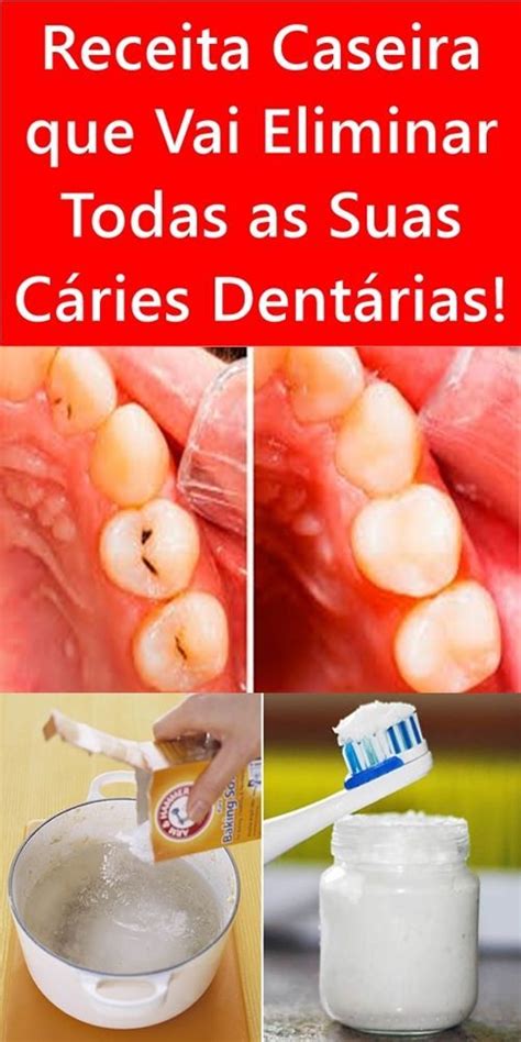 Receita Caseira Que Vai Eliminar Todas As Suas Cáries Dentárias