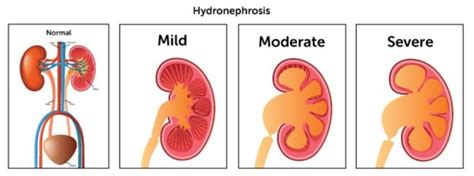 Hydronephrosis - Definition, What is, Symptoms, Treatment, Causes