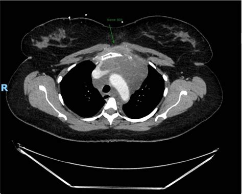 CT scan demonstrating anterior invasion of mediastinum. | Download ...