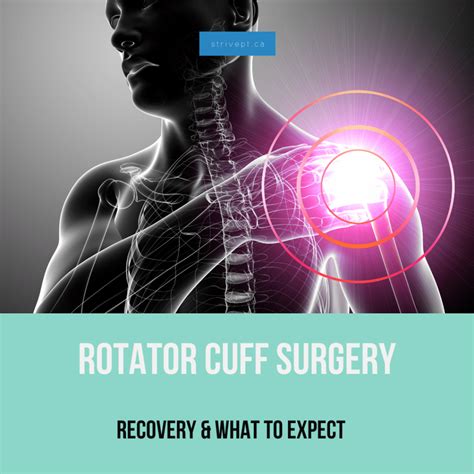 Rotator Cuff Surgery and Recovery : Shoulder Surgery