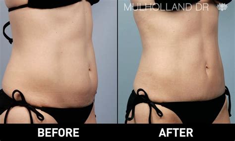 Liposuction Before And After Photos In Toronto Spamedica Liposuction Body Contouring