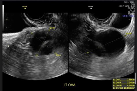 Septated Ovarian Cyst Rhysterectomy