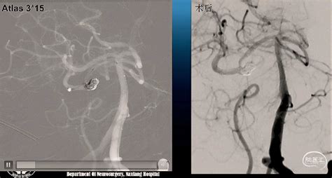 使用atlas支架治疗颅内动脉瘤10例 脑医汇 神外资讯 神介资讯