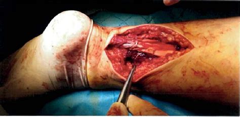 Surgical Appearance Of Achilles Tendon Rupture Of The Patient During