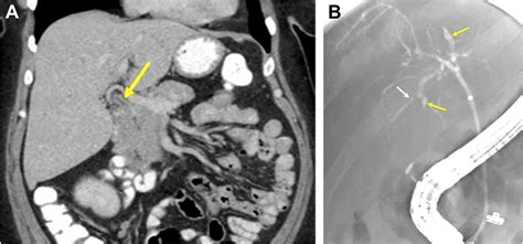 Diagnostic Tests In Primary Sclerosing Cholangitis Clinics In Liver Disease