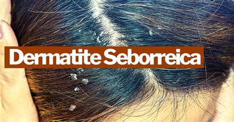 O Que Causa Seborreia No Cabelo - Dermatite Seborreica: causas e sintomas - Pharma Scalabis