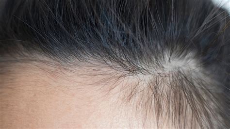 What Causes Broken Hairs Along Your Hairline And How To Fix Them Glamour Uk