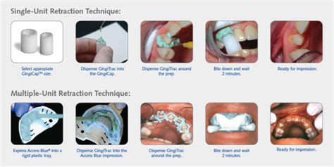 Gingitrac™ Cordless Gingival Retraction System