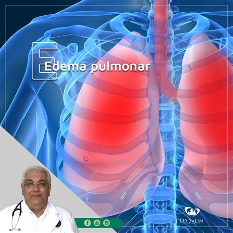 Derrame Pleural Sintomas Causas E Tratamento Dr Salim CRM SP 43163