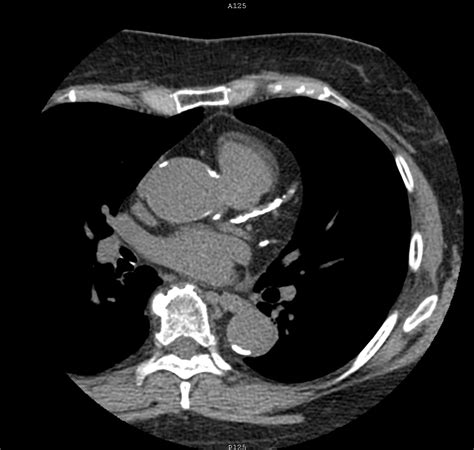 Ct Coronary Calcium Score Cardiovascular Interventions Orlando