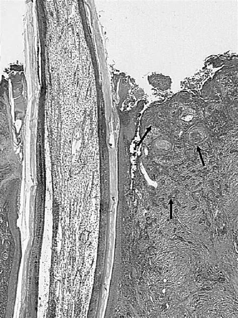 Histologic Section From A Biopsy Sample Of The Uropygial Mass On The