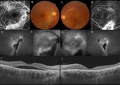 A Year Old Male Patients With Central Serous Chorioretinopathy In