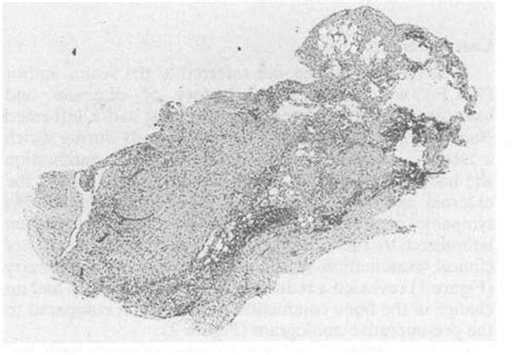 Low Power View Of The Surgically Excised Tissue After Removal Of The