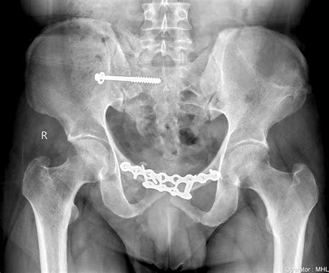 Scielo Brasil Ct Guided Percutaneous Sacroiliac Stabilization In