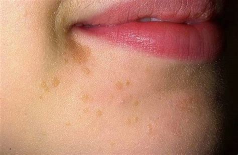 Flat Warts: Symptoms, Causes, and Ways of Treatment - Med Warts