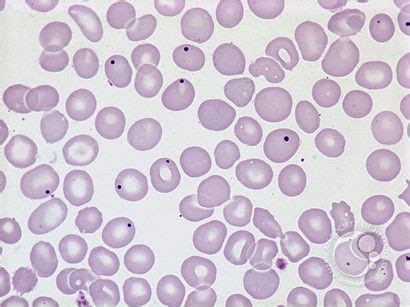 Howell-Jolly bodies - 1. | Medical laboratory scientist, Hematology ...