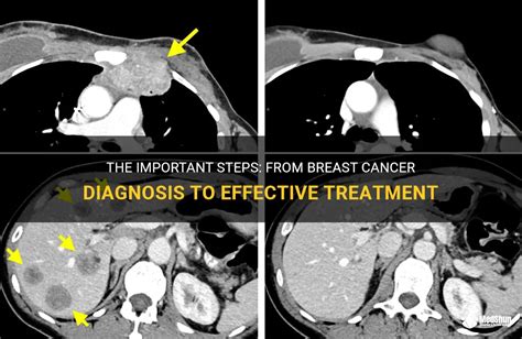 The Important Steps: From Breast Cancer Diagnosis To Effective ...