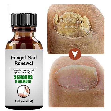 Nail Ingrown Repair Solution Anti-Infection Onychomycosis Paronychia