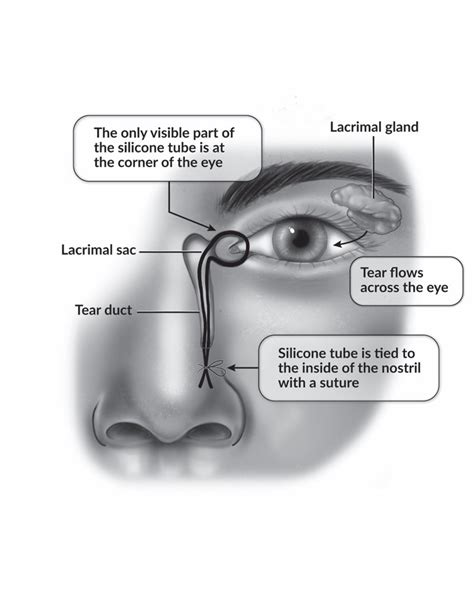 Nasolacrimal Duct Eye Model