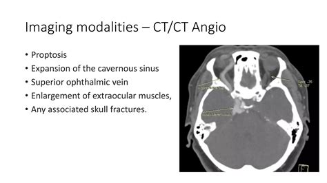 Carotid Cavernous Fistulas Ppt